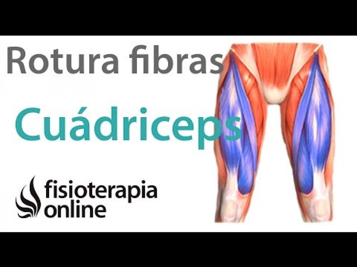 rotura fibrilar cuadriceps por golpe